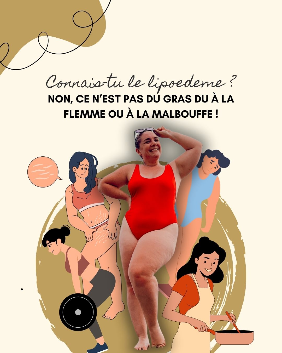 Le lipoedème est une maladie chronique qui provoque une accumulation anormale et symétrique de graisse, le plus souvent sur les jambes et parfois les bras, sans toucher les mains ni les pieds. Contrairement à une prise de poids classique, cette graisse est douloureuse, résistante aux régimes et influencée par les hormones, en particulier lors de la puberté, de la grossesse ou de la ménopause. Souvent confondu avec de l’obésité ou de la cellulite, le lipœdème est pourtant une pathologie à part entière qui nécessite un diagnostic et une prise en charge adaptés.