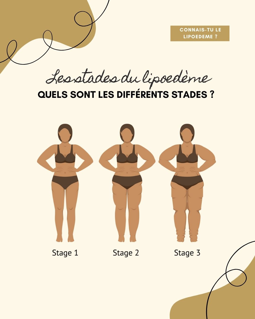 Le lipoedème est une maladie chronique qui provoque une accumulation anormale et symétrique de graisse, le plus souvent sur les jambes et parfois les bras, sans toucher les mains ni les pieds. Contrairement à une prise de poids classique, cette graisse est douloureuse, résistante aux régimes et influencée par les hormones, en particulier lors de la puberté, de la grossesse ou de la ménopause. Souvent confondu avec de l’obésité ou de la cellulite, le lipœdème est pourtant une pathologie à part entière qui nécessite un diagnostic et une prise en charge adaptés.