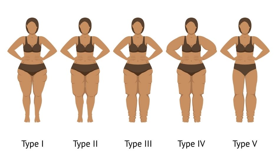 Le lipoedème est une maladie chronique qui provoque une accumulation anormale et symétrique de graisse, le plus souvent sur les jambes et parfois les bras, sans toucher les mains ni les pieds. Contrairement à une prise de poids classique, cette graisse est douloureuse, résistante aux régimes et influencée par les hormones, en particulier lors de la puberté, de la grossesse ou de la ménopause. Souvent confondu avec de l’obésité ou de la cellulite, le lipœdème est pourtant une pathologie à part entière qui nécessite un diagnostic et une prise en charge adaptés.