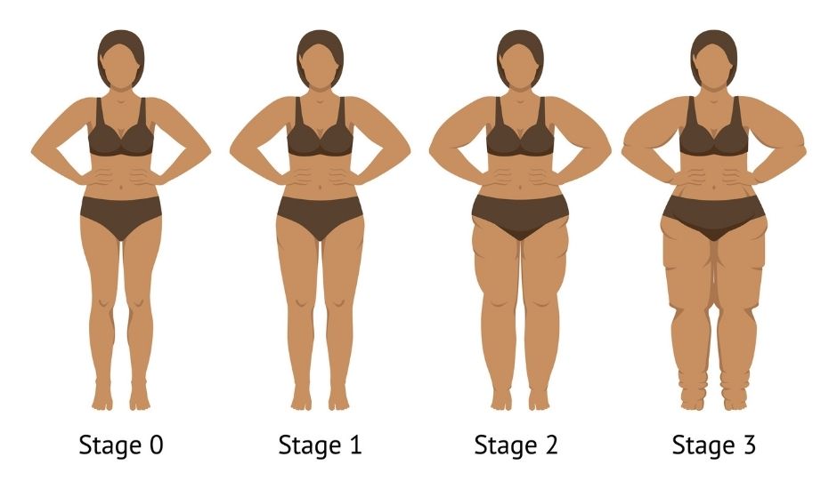 Le lipoedème est une maladie chronique qui provoque une accumulation anormale et symétrique de graisse, le plus souvent sur les jambes et parfois les bras, sans toucher les mains ni les pieds. Contrairement à une prise de poids classique, cette graisse est douloureuse, résistante aux régimes et influencée par les hormones, en particulier lors de la puberté, de la grossesse ou de la ménopause. Souvent confondu avec de l’obésité ou de la cellulite, le lipœdème est pourtant une pathologie à part entière qui nécessite un diagnostic et une prise en charge adaptés.