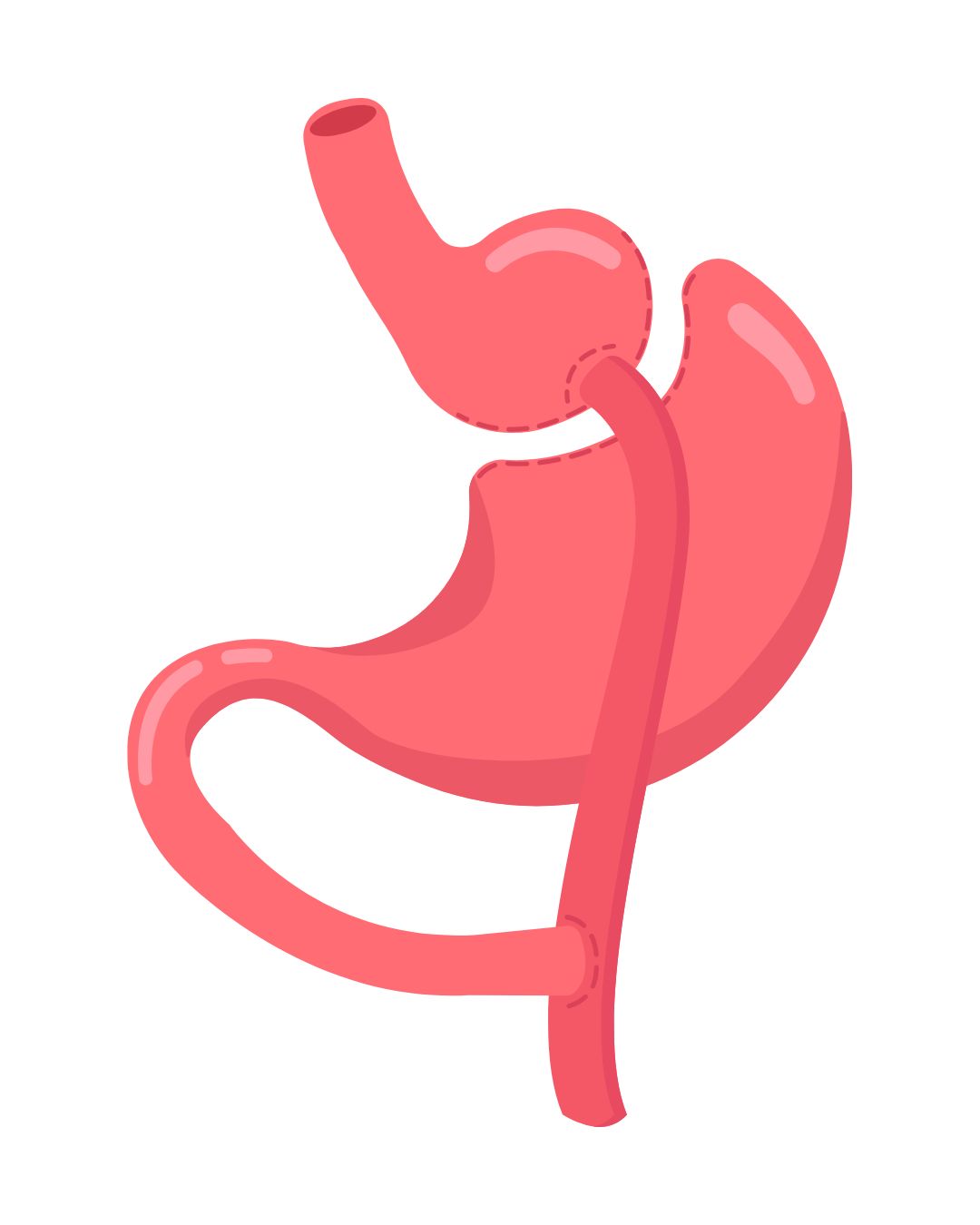 La chirurgie bariatrique est un traitement médical destiné aux personnes souffrant d’obésité sévère ou de complications métaboliques comme le diabète ou la résistance à l’insuline. Elle regroupe plusieurs techniques, dont la sleeve gastrectomie et le bypass gastrique, qui modifient le système digestif pour favoriser une perte de poids durable. Avant de se lancer, il est essentiel de comprendre son fonctionnement, ses critères d’éligibilité et le parcours pré-opératoire.