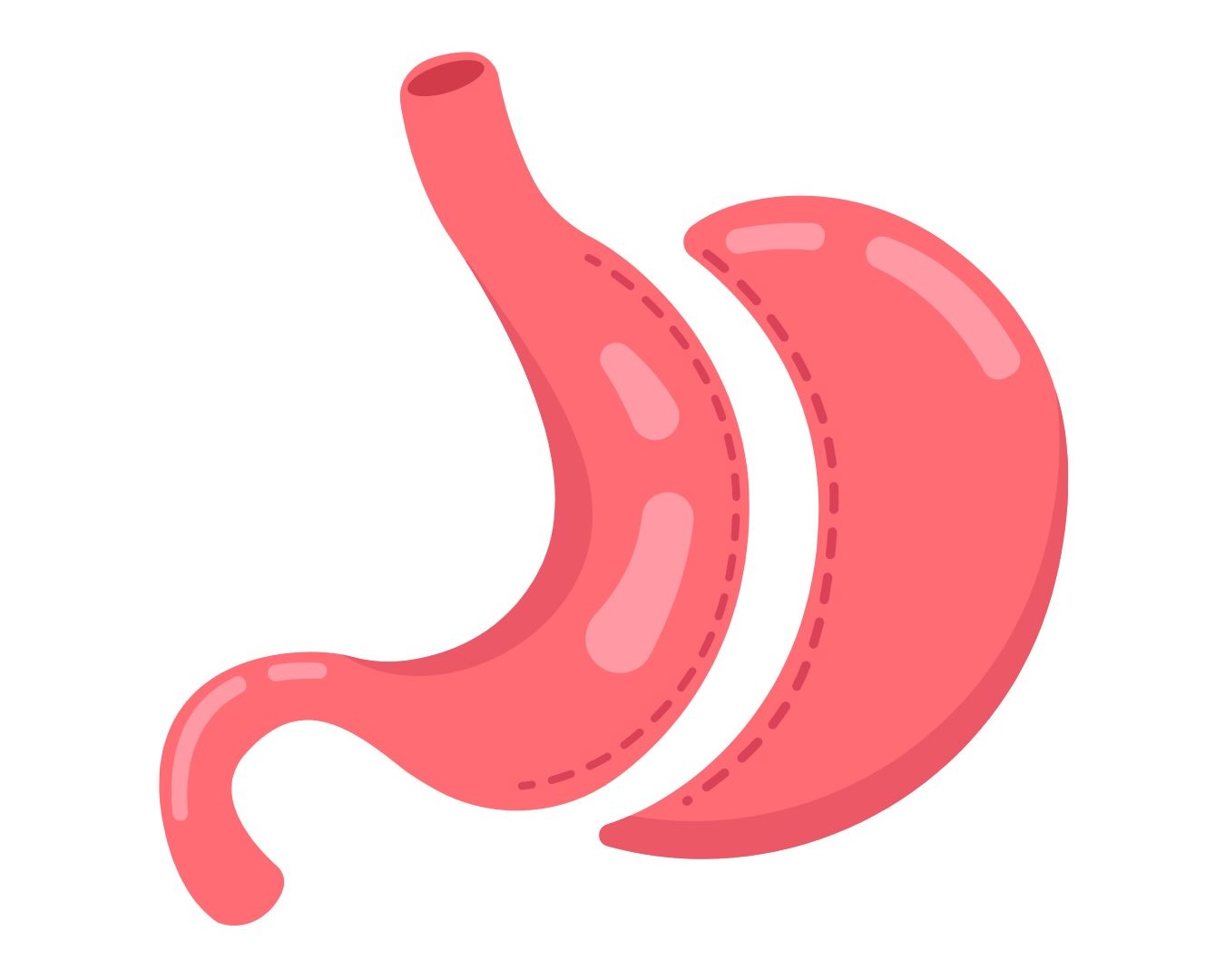 La chirurgie bariatrique est un traitement médical destiné aux personnes souffrant d’obésité sévère ou de complications métaboliques comme le diabète ou la résistance à l’insuline. Elle regroupe plusieurs techniques, dont la sleeve gastrectomie et le bypass gastrique, qui modifient le système digestif pour favoriser une perte de poids durable. Avant de se lancer, il est essentiel de comprendre son fonctionnement, ses critères d’éligibilité et le parcours pré-opératoire.