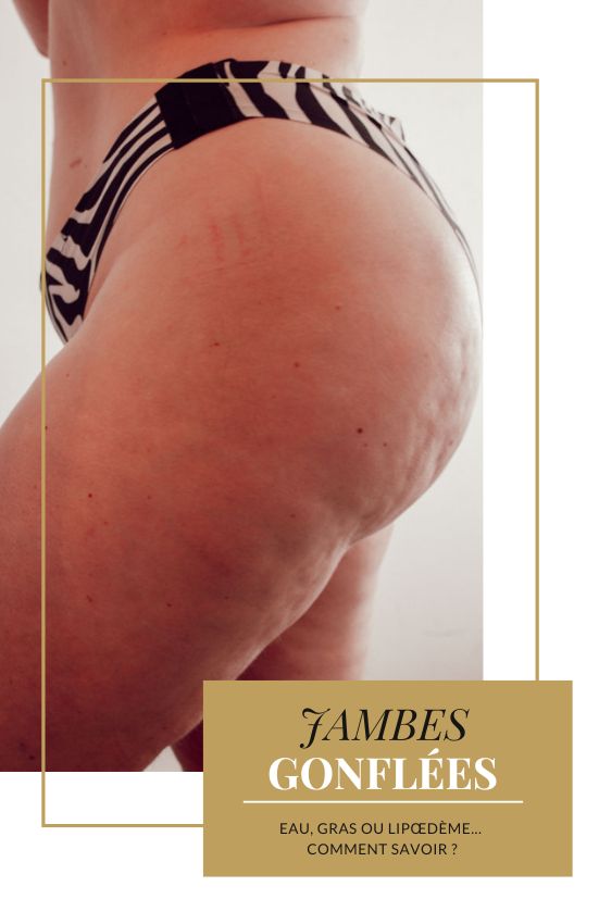 La rétention d’eau correspond à une accumulation de liquide dans les tissus, souvent temporaire et fluctuante, qui donne une sensation de gonflement au fil de la journée. La prise de gras, elle, est un stockage d’énergie progressif, généralement stable, qui modifie la silhouette sans provoquer de douleur. Le lipœdème, enfin, est une condition spécifique associée à une graisse résistante, une inflammation chronique et une rétention d’eau secondaire, ce qui le rend plus complexe à identifier et à prendre en charge.